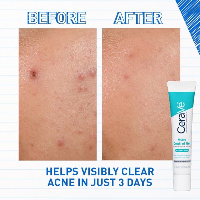 Acne Control Gel